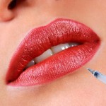 Hyaluronic Acid Dermal Filler For Fuller Lips